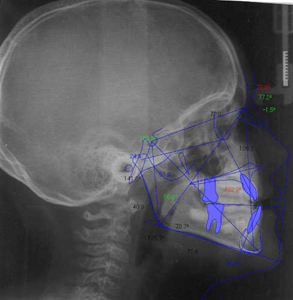 implantologia_post-estrattiva_1